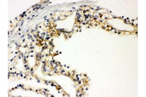 Anti- SLC12A1 Picoband antibody, IHC(P) IHC(P): Human Kidney Cancer Tissue (SLC12A1 antibody  (N-Term))