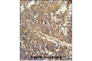 ATP13A3 antibody (N-term) (ABIN652119 and ABIN2840555) immunohistochemistry analysis in formalin fixed and paraffin embedded human bladder carcinoma followed by peroxidase conjugation of the secondary antibody and DAB staining. (ATP13A3 antibody  (N-Term))