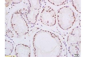 Formalin-fixed and paraffin embedded human esophageal carcinoma labeled with Rabbit Anti-PPAR delta Polyclonal Antibody, Unconjugated  at 1:200 followed by conjugation to the secondary antibody and DAB staining (PPARD antibody  (AA 2-100))