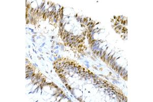Immunohistochemistry of paraffin-embedded human colon carcinoma using HNF-4-alpha Rabbit mAb (ABIN7267621) at dilution of 1:150 (40x lens).