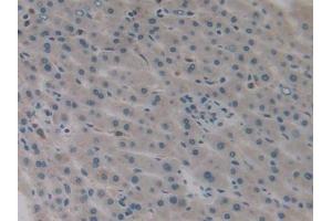 Detection of IL1a in Human Liver cancer Tissue using Monoclonal Antibody to Interleukin 1 Alpha (IL1a) (IL1A antibody  (AA 113-271))