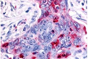 Anti-MST1R / RON antibody  ABIN1049082 IHC staining of human colon carcinoma. (MST1R antibody  (C-Term))
