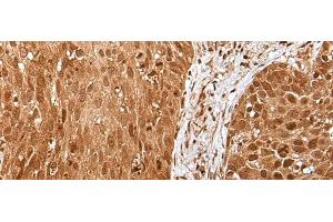 Immunohistochemistry of paraffin-embedded Human lung cancer tissue using UBA7 Polyclonal Antibody at dilution of 1:35(x200) (UBA7 antibody)