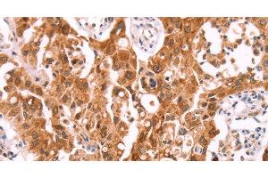 Immunohistochemistry of paraffin-embedded Human lung cancer using NCEH1 Polyclonal Antibody at dilution of 1:80 (NCEH1 antibody)