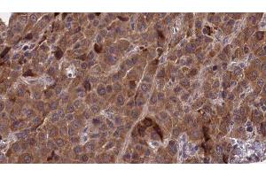 ABIN6277268 at 1/100 staining Human liver cancer tissue by IHC-P. (PAK1 antibody  (N-Term))