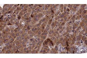 ABIN6277268 at 1/100 staining Human liver cancer tissue by IHC-P.
