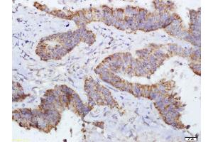 Paraformaldehyde-fixed, paraffin embedded Human colon cancer Antigen retrieval by boiling in sodium citrate buffer (pH6. (DERL1 antibody  (AA 111-220))