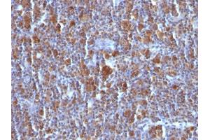 Formalin-fixed, paraffin-embedded Hodgkin's Lymphoma stained with BAX Mouse Monoclonal Antibody (BAX/962). (BAX antibody)