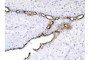 IHC analysis of MUC1 using anti-MUC1 antibody . (MUC1 antibody  (AA 1062-1139))