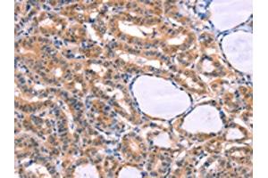 The image on the left is immunohistochemistry of paraffin-embedded Human thyroid cancer tissue using ABIN7129127(CYP1B1 Antibody) at dilution 1/20, on the right is treated with fusion protein. (CYP1B1 antibody)