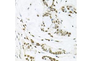 Immunohistochemistry of paraffin-embedded human gastric cancer using MAPK8 antibody (ABIN5970116) at dilution of 1/100 (40x lens). (JNK antibody)