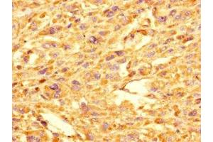 Immunohistochemistry of paraffin-embedded human melanoma using ABIN7154300 at dilution of 1:100 (GOLPH3L antibody  (AA 6-285))