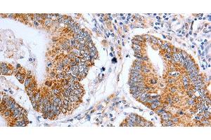 Immunohistochemistry of paraffin-embedded Human colon cancer tissue using Claudin 10 Polyclonal Antibody at dilution 1:50