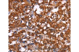 Immunohistochemistry of Human gastric cancer using GAGE12I Polyclonal Antibody at dilution of 1:30