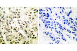 Peptide - +Immunohistochemical analysis of paraffin-embedded human breast carcinoma tissue using CREB (Ab-129/133) antibody (#B7053). (CREB1 antibody  (Ser129, Ser133))