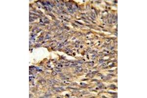 Formalin-fixed and paraffin-embedded human lung carcinoma reacted with HBA2 Antibody (Center) followed which was peroxidase-conjugated to the secondary antibody, followed by DAB staining. (HBA1 antibody  (Middle Region))