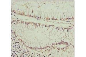 Immunohistochemistry of paraffin-embedded human colon cancer using ABIN7163634 at dilution of 1:100 (PDGFRL antibody  (AA 15-205))