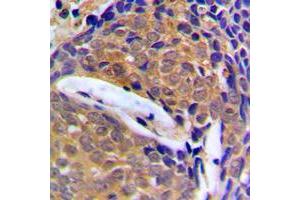 Immunohistochemical analysis of Cystatin B staining in human breast cancer formalin fixed paraffin embedded tissue section. (CSTB antibody  (Center))