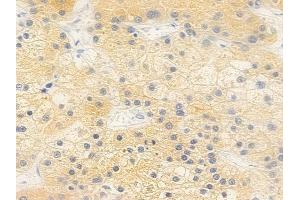 ABIN6264089 and ABIN6279283 at 1/100 staining human hepatocellular carcinoma by IHC-P.