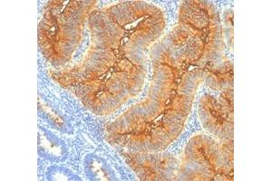 Immunohistochemical staining (Formalin-fixed paraffin-embedded sections) of human colon cancer with TAG-72 monoclonal antibody, clone B72.