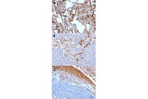 Immunohistochemical staining (Formalin-fixed paraffin-embedded sections) of human melanoma (A, B) and human tonsil (C) with MCAM monoclonal antibody, clone MUC18/1130 . (MCAM antibody)