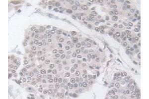 Detection of GPX3 in Human Prostate cancer Tissue using Polyclonal Antibody to Glutathione Peroxidase 3, Plasma (GPX3) (GPX3 antibody  (AA 21-72))