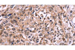 Immunohistochemistry of paraffin-embedded Human esophagus cancer using AMIGO2 Polyclonal Antibody at dilution of 1:50 (AMIGO2 antibody)