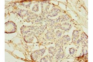 Immunohistochemistry of paraffin-embedded human breast cancer using ABIN7162370 at dilution of 1:100 (OSGIN2 antibody  (AA 1-250))