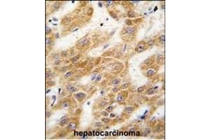 Formalin-fixed and paraffin-embedded human hepatocarcinoma tissue reacted with ALDH4A1 antibody (C-term), which was peroxidase-conjugated to the secondary antibody, followed by DAB staining.