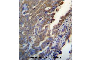 ASB4 Antibody (C-term) (ABIN657170 and ABIN2846303) immunohistochemistry analysis in formalin fixed and paraffin embedded human ovarian carcinoma followed by peroxidase conjugation of the secondary antibody and DAB staining. (ASB4 antibody  (C-Term))
