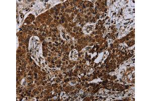 Immunohistochemistry of Human liver cancer using NDUFA4 Polyclonal Antibody at dilution of 1:40 (NDUFA4 antibody)