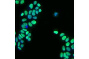 Immunofluorescent staining of human breast adenocarcinoma.