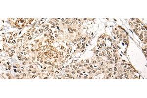 Immunohistochemistry of paraffin-embedded Human prost ate cancer tissue using BATF Polyclonal Antibody at dilution of 1:45(x200) (BATF antibody)