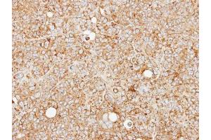 IHC-P Image Immunohistochemical analysis of paraffin-embedded SW480 xenograft, using MCCC2, antibody at 1:100 dilution. (MCCC2 antibody  (Center))