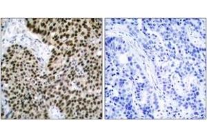 Immunohistochemistry analysis of paraffin-embedded human breast carcinoma tissue, using HSF1 (Ab-303) Antibody. (HSF1 antibody  (AA 270-319))