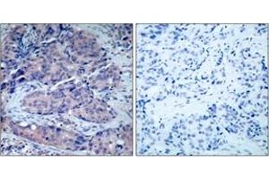 Immunohistochemistry analysis of paraffin-embedded human breast carcinoma tissue, using SEK1/MKK4 (Ab-261) Antibody. (MAP2K4 antibody  (AA 227-276))