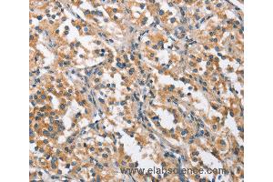 Immunohistochemistry of Human thyroid cancer using CHMP1A Polyclonal Antibody at dilution of 1:60 (CHMP1A antibody)