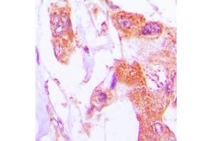 Immunohistochemical analysis of Involucrin staining in human lung cancer formalin fixed paraffin embedded tissue section.