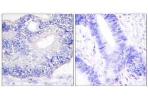 Immunohistochemical analysis of paraffin-embedded human colon carcinoma tissue, using TGF alpha antibody (ABIN5976518).