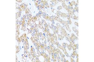 Immunohistochemistry of paraffin-embedded human liver injury using CHD1 antibody at dilution of 1:100 (x40 lens).