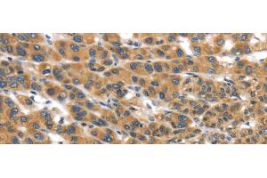 Immunohistochemistry of paraffin-embedded Human liver cancer tissue using UBTD2 Polyclonal Antibody at dilution 1:35 (UBTD2 antibody)
