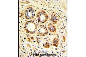 Formalin-fixed and paraffin-embedded human breast carcinoma with, which was peroxidase-conjugated to the secondary antibody, followed by DAB staining.