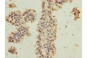 Immunohistochemistry of paraffin-embedded human breast cancer using ABIN7174707 at dilution of 1:100 (RPAP2 antibody  (AA 1-154))