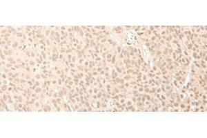 Immunohistochemistry of paraffin-embedded Human esophagus cancer tissue using CNOT10 Polyclonal Antibody at dilution of 1:50(x200) (CNOT10 antibody)