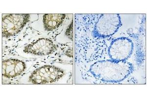 Immunohistochemistry analysis of paraffin-embedded human colon carcinoma tissue using ATR (Phospho-Ser428) antibody.