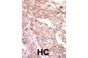 Formalin-fixed and paraffin-embedded human hepatocellular carcinoma tissue reacted with EPHA1 polyclonal antibody  , which was peroxidase-conjugated to the secondary antibody, followed by AEC staining. (EPHA1 antibody  (N-Term))