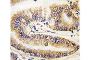 IHC analysis of FFPE human lung carcinoma tissue stained with PTEN antibody (PTEN antibody  (AA 69-104))