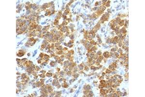 IHC testing of FFPE human parathyroid tumor with TL1A antibody (clone TLRM1-1).
