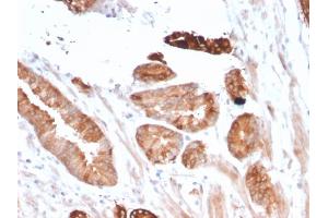 Formalin-fixed, paraffin-embedded human Breast Carcinoma stained with Flt3 / CD135 Mouse Monoclonal Antibody (FLT3/2458). (FLT3 antibody)