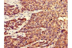 Immunohistochemistry of paraffin-embedded human ovarian cancer using ABIN7148931 at dilution of 1:100 (CDK5 antibody  (AA 1-292))